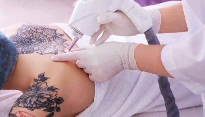 آشنایی با روش های پاک کردن تاتو بدن