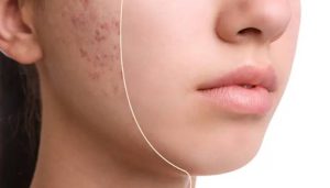 اندولیفت جای جوش