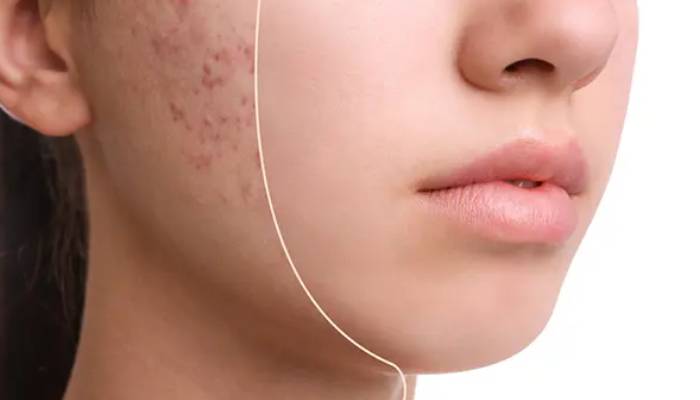 اندولیفت جای جوش