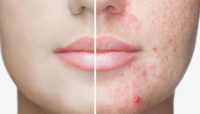 معرفی انواع جوش صورت