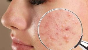 معرفی انواع جوش صورت