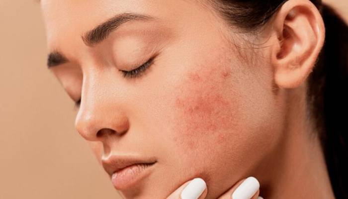 معرفی انواع جوش صورت