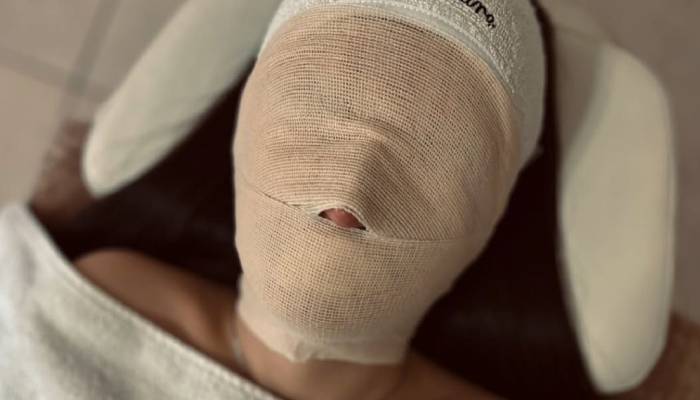 کربوکسی تراپی در فیشیال