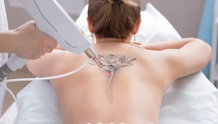 بهترین روش برای از بین بردن تاتو