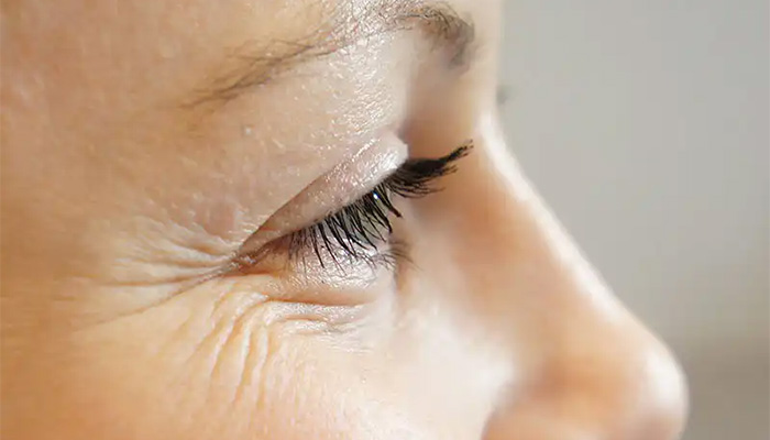 بهترین روش درمان چین و چروک زیر چشم