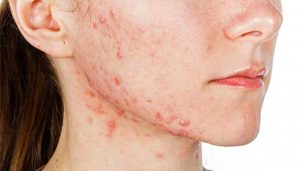 مدل های مختلف جوش صورت