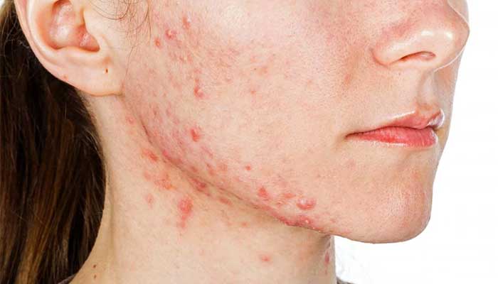 مدل های مختلف جوش صورت